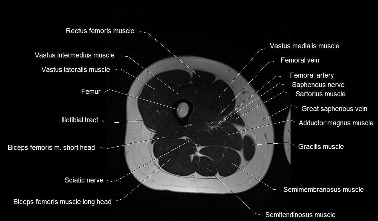 MRI thigh cross sectional anatomy image 36.webp